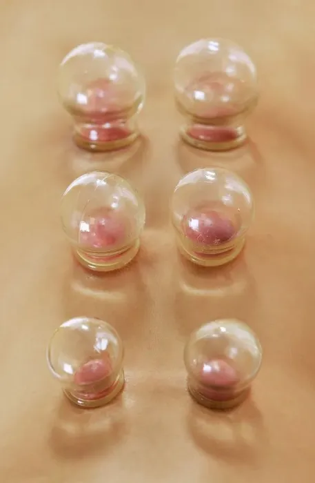 Stampa con cornice : Cupping. MODEL RILASCIO DI CREDITI. Cupping Stampa con cornice : Cupping. MODEL RILASCIO DI CREDITI. Cupping