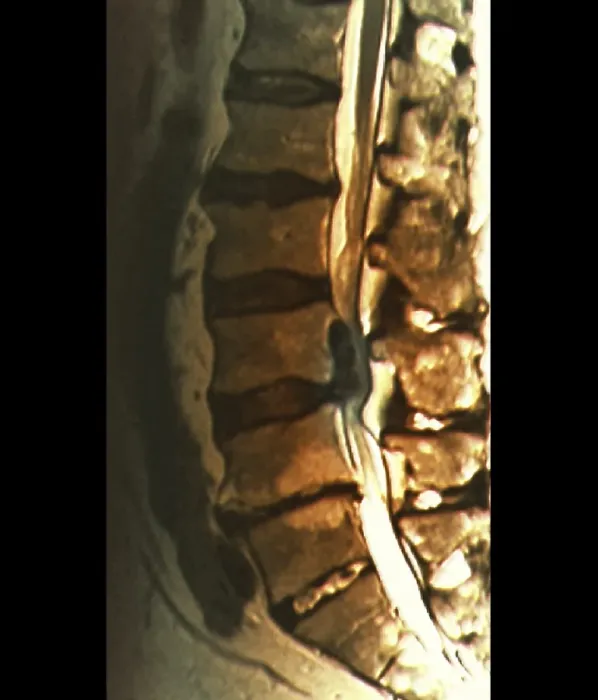 Stampa con cornice : Sciatica, risonanza magnetica Stampa con cornice : Sciatica, risonanza magnetica