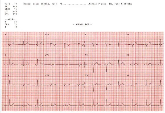 Stampa con cornice : Elettrocardiogramma normale. Stampa con cornice : Elettrocardiogramma normale.