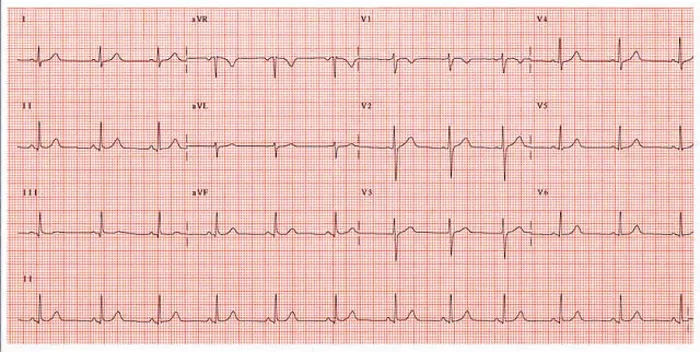 Stampa con cornice : Elettrocardiogramma normale.