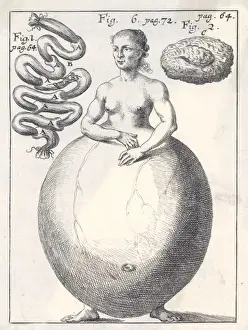 19th Century Medical Art Stampe: Hideous Deformity