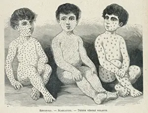 Historical Medical Images Stampe: Measles Compared