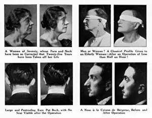 Plastic Surgery Before And After Stampe: Plastic Surgery - Before and After