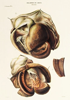 Stampe di Aneurisma aortico. Artwork from Jean Cruveilhiers medical textbook Anatomie pathalogique del corpo umano, pubblicato nel 1835 Immagini datate 2007 gennaio: Aneurisma aortico