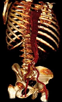 Stampe di Dissezione dell'aortica. 3D CT scan di un uomo di 67 anni con dissezione dell'aortica. L'aorta è il grande arterio del corpo che scende verticalmente al centro (rosso) Immagini datate 2008 marzo: Dissezione aortica, scannaggio in rilievo tridimensionale con CT