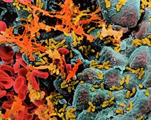 Stampe di Infezione batterica del bladder (cistite). Immagine a raggi X di colore dello scannatore elettroneo SEM dell'uretra umana mostrando infezione batterica Immagini datate 1994: Infezione del tratto urinario superiore