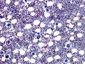 Stampe di Ossa del midollo osseo, micrografia a luce debole. Le grandi cellule blu sono megacariociti che formano placelle di sangue Immagini datate 2010 marzo: Marrow ossea, fotografia a lente di ingrandimento leggera