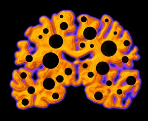 Stampe di Danni al cervello. Conceptuale rappresentazione grafica del danneggiamento cerebrale come buchi su una scansione di risonanza magnetica a colori (CT) umana del cervello Immagini datate 2000: Danno al cervello