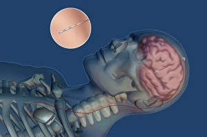 Deep Brain Stimulation Stampe: Brain pacemaker, artwork