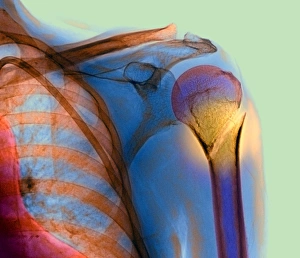 Osso del braccio superiore rotto, radiografia