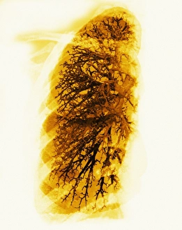 Lung Anatomy Stampe: Bronchioles