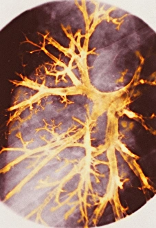 Stampe di Broncite. Grafia colorata del broncoscopio (X-raglio) dei bronchioli gonfiati (arancione) nel polmone destro Immagini datate 2005 giugno: Bronchite, radiografia