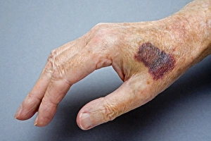 Stampe di RILASCIO DEL MODELLO. Mano incolpata, lesione della mano con lividi sulla mano di una persona Immagini datate 2008 aprile: Mano sanguinato