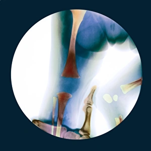 Stampe di Corretta distorsione del ginocchio. Radiografia colorata del ginocchio distorto e rotto di una bambina femmina che viene manipolato per essere riposto in posizione correta Immagini datate 2007 febbraio: Dislocazione del ginocchio corretta, radiografia