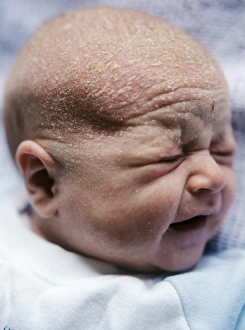 Stampe di MODEL RILASCIO DI IMMIGRAZIONE. Cradle cap. Neonato affetto da cradle cap (crusta lactea). Si vedono lesioni grigio gialle in macchie intorno alla testa del neonato Immagini datate 2005 settembre: Capo da allattamento