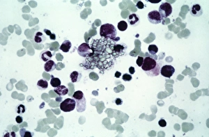 Light Microscopy Images Stampe: Cystine in bone marrow, light micrograph