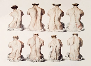 19th Century Medical Illustrations Stampe: Back deformities
