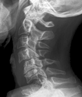 Stampe di Righezza X dietro l'occhio del collo nel paziente di 57 anni che mostra ossa vertebrale dislocate (C5 - C6) dopo un incidente automobilistico Immagini datate 2011 aprile: Osso del collo dislocato, raggiX