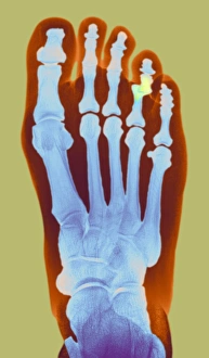 Stampe di Dito scelto. Radiografia X di colore del piede della donna 49 anni con un dito scelto, la giunzione dislocata è mostrata in giallo Immagini datate 2008 gennaio: Dito dislocato, radiografia