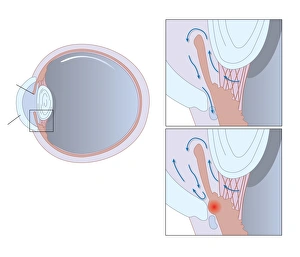 Glaucoma Treatment Stampe: Glaucoma, artwork