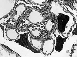 Stampe di Glomerulus. Micrografia elettronegativa di trasmissione (TEM) di una sezione attraverso un nefrone in un rene umano, mostrando uno schiuma di capillari all'interno del corpuscolo renale Immagini datate 2013 febbraio: Globulo renale, TEM