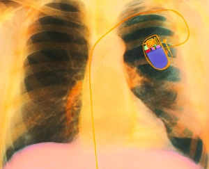 Stampe di Un pompa del cuore. Radiografia X colorata della colonna vertebrale di un paziente, che mostra una pompa del cuore fissata al posto corretto Immagini datate 1994: Pacemaker del cuore