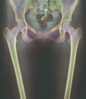 Stampe di I articolazioni del ginocchio. Radiografia a colori di una donna con il collo e le gambe superiori, che rivelano i ossa che formano l'articolazione dei suoi ginocchi Immagini datate 2002: Osso sacro, radiografia