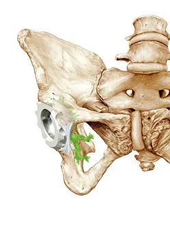 Stampe di Sostituzione del ginocchio. L'opera d'arte di un'anca protetica con una camera per l'anca che si trova nel petto della colonna vertebrale Immagini datate 2011 giugno: Sostituzione di ginocchia con opera d'arte