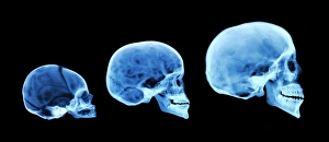 Stampe di Lo sviluppo del cranio umano. Radiografia colorata di tre crani umani, compresi un neonato, un bambino e una persona adulta Immagini datate 2006 aprile: Sviluppo del cranio umano