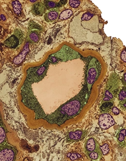 Coloured TEM Images Stampe: Hydronephrosis
