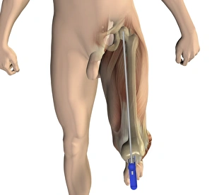 Osteoarthritis Treatment Options Stampe: Knee replacement alignment, artwork