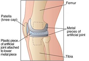 Osteoarthritis Treatment Stampe: Knee replacement, artwork