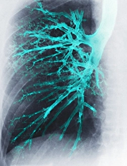 Respiratory System Diagram Stampe: Lung, X-ray
