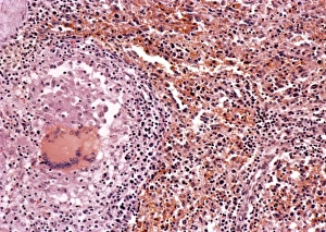 Mycobacterium Tuberculosis Bacteria Stampe: Miliary tuberculosis, light micrograph