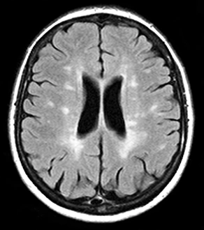 Stampe di Sclerosi multipla, risonanza magnetica Immagini datate 2012 marzo: Sclerosis multipla, esame di risonanza magnetica