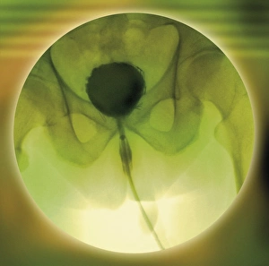 Bladder normale, cistoscopia