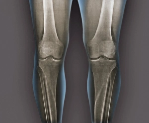 Stampe di Knee normali. Radiografie frontali colorate delle ginocchia sane di un uomo di 35 anni Immagini datate 2013 aprile: Gambi normali, radiografie