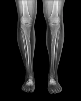 Xray Stampe: Gambi normali, raggi X