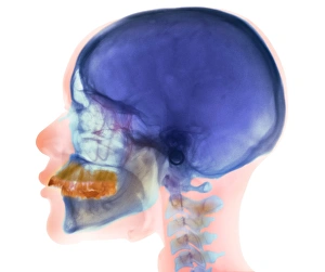 Stampe di Overbito. Radiografia coloreata dell'osso cranico (prospetto laterale) di una donna di 32 anni che mostra l'overbito della mandibola superiore (giallo) e dei denti Immagini datate 2006 novembre: Sfere di sottosposizione, radiografia