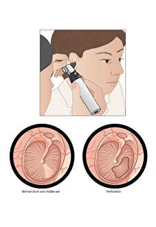 Stampe di Il tamburo orecchiale sottile ed è facilmente rotto da traumi, infezioni, rumori fortissimi oppure l'insertione di un oggetto estraneo nel canale dell'orecchio Immagini datate 19 agosto 2010: Orecchina perforata, arte