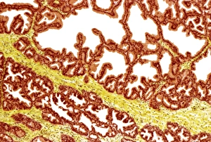 Glandola prostatica, fotografia a lente leggera