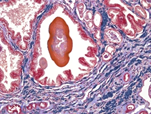 Stampe di Glandola Prostata. Microfotografia leggera di una sezione attraverso la glandola prostata che mostra un concreto (rosso) di materiali secretori in un alveolo prostatico (spazio aereo) Immagini datate 2010 settembre: Micrografo prostatico leggero
