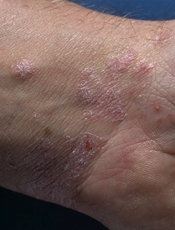 Stampe di Le lesioni di psoriasi sulla pelle del polso di un uomo sono una malattia della pelle comune che comporta un aumento significativo nella velocità di produzione delle cellule dell'epidermide Immagini datate 2003 giugno: Psoriasis