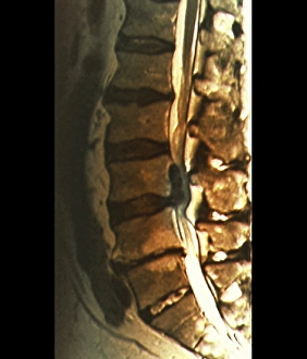 Immagini datate 27 marzo 2013: Sciatica, risonanza magnetica
