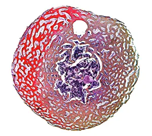 Stampe di Osso spugnoso. Micrografia a luce leggera di una sezione attraverso un osso spugnoso umano trattato e decalcificato, con colorazione. Questo tipo di ossone è anche chiamato osso cancelloso Immagini datate 2008 novembre: Osso spugnoso, micrografo leggero