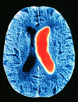 Computed Tomography Scans Stampe: Stroke