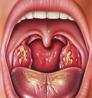 Stampe di Tonsillite. L'opera d'arte della bocca e del collo di un paziente con le tonsille infiammate aperte Immagini datate 2004 settembre: Tonsillitis