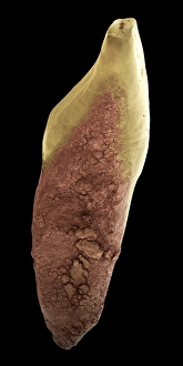 Stampe di Decidura dentaria. Immagine di elettroni scarabici (SEM) colorata del placido dentistario (brunero) su un incisivo umano Immagini datate 2006 maggio: Decadenza dei denti, SEM