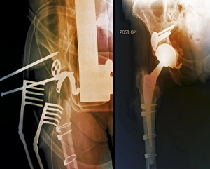 Hip Replacement Surgery Stampe: Total hip replacement, X-rays