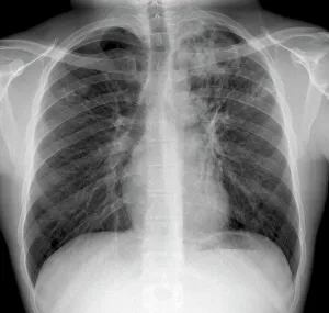 Mycobacterium Tuberculosis Bacteria Stampe: Tuberculosis, X-ray
